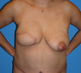 Patient 622 - Surgery 2 Photo 3 - Breast Augmentation Mastopexy Tissue Expander Implant DIEP Flap Surgery - Breast Cancer Texas