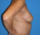 Patient 622 - Surgery 2 Photo 5 - Breast Augmentation Mastopexy Tissue Expander Implant DIEP Flap Surgery - Breast Cancer Texas