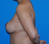 Patient 622 - Surgery 4 Photo 1 - Breast Augmentation Mastopexy Tissue Expander Implant DIEP Flap Surgery - Breast Cancer Texas