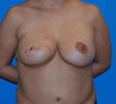 Patient 622 - Surgery 4 Photo 3 - Breast Augmentation Mastopexy Tissue Expander Implant DIEP Flap Surgery - Breast Cancer Texas