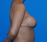 Patient 622 - Surgery 4 Photo 5 - Breast Augmentation Mastopexy Tissue Expander Implant DIEP Flap Surgery - Breast Cancer Texas