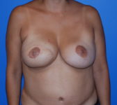 Patient 622 - Surgery 5 Photo 3 - Breast Augmentation Mastopexy Tissue Expander Implant DIEP Flap Surgery - Breast Cancer Texas