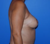 Patient 622 - Surgery 5 Photo 5 - Breast Augmentation Mastopexy Tissue Expander Implant DIEP Flap Surgery - Breast Cancer Texas