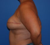 Patient 689 - Surgery 2 Photo 1 - Tissue Expander Implant Latissimus Muscle - Breast Cancer Texas