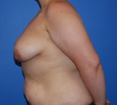 Patient 435 Before Surgey Photo 1 - Breast Augmentation Mastopexy Tissue Expander Implant DIEP Flap Surgery - Breast Cancer Texas