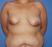 Patient 435 Before Surgey Photo 3 - Breast Augmentation Mastopexy Tissue Expander Implant DIEP Flap Surgery - Breast Cancer Texas