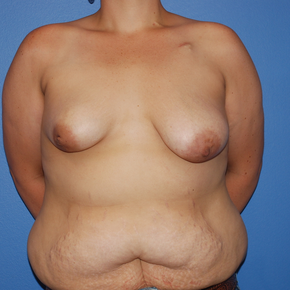 Patient 435 Before Overview - Sidebar - Breast Augmentation Mastopexy Tissue Expander Implant DIEP Flap Surgery - Breast Cancer Texas