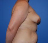 Patient 435 Before Surgey Photo 5 - Breast Augmentation Mastopexy Tissue Expander Implant DIEP Flap Surgery - Breast Cancer Texas
