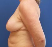 Patient 812 Before Surgey Photo 1 - DIEP Flap Surgery - Breast Cancer Texas