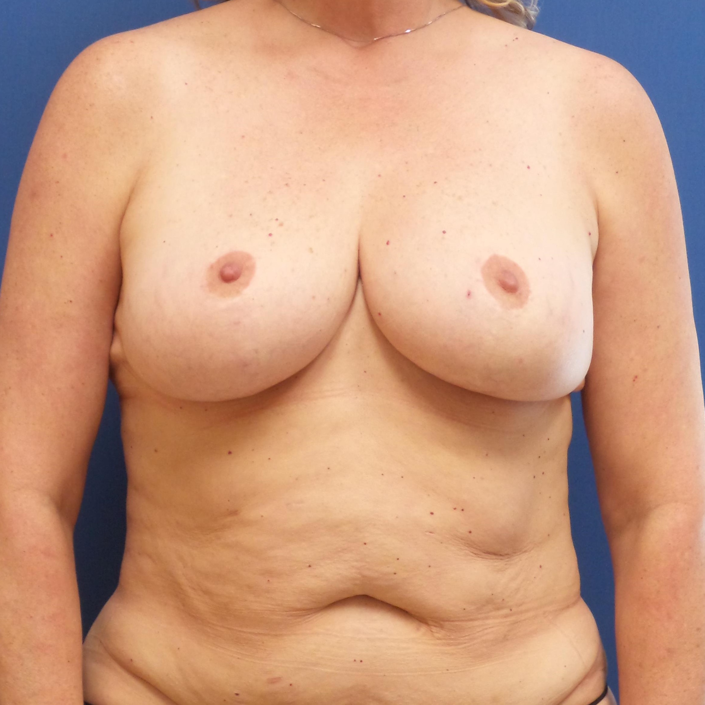 Patient 812 Before Overview - DIEP Flap Surgery - Breast Cancer Texas