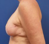 Patient 812 - Surgery 1 Photo 1 - DIEP Flap Surgery - Breast Cancer Texas