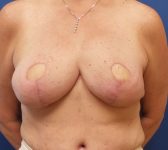 Patient 812 - Surgery 1 Photo 3 - DIEP Flap Surgery - Breast Cancer Texas