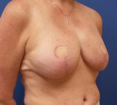 Patient 812 - Surgery 1 Photo 4 - DIEP Flap Surgery - Breast Cancer Texas