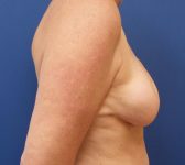 Patient 812 - Surgery 1 Photo 5 - DIEP Flap Surgery - Breast Cancer Texas