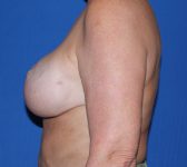 Patient 812 - Surgery 2 Photo 1 - DIEP Flap Surgery - Breast Cancer Texas