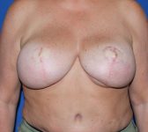 Patient 812 - Surgery 2 Photo 3 - DIEP Flap Surgery - Breast Cancer Texas