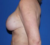 Patient 812 - Surgery 3 Photo 1 - DIEP Flap Surgery - Breast Cancer Texas